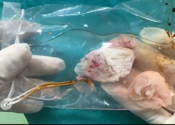 Choáng với ổ sán não khổng lồ cư trú trong não nam bệnh nhân ở Phú Thọ