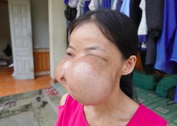 Người phụ nữ 15 năm mang “gương mặt của quỷ” ở Phú Thọ