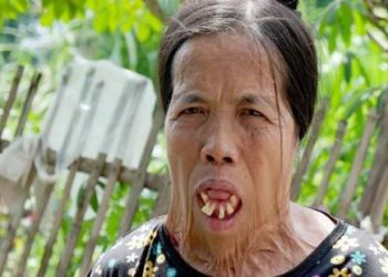 Phú Thọ: Người phụ nữ gần 50 năm không ngậm được miệng