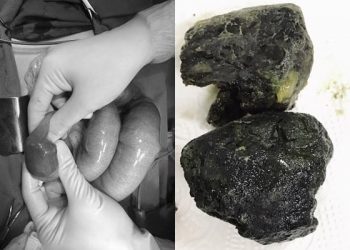 Uống trà sữa thay cơm, nam thanh niên 20 tuổi ở Phú Thọ suýt chết vì tắc ruột