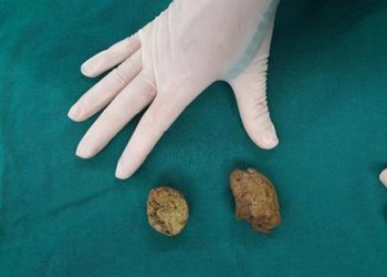 Ăn nhiều măng xào, bé 6 tuổi ở Phú Thọ phải nhập viện ‘thông ruột’