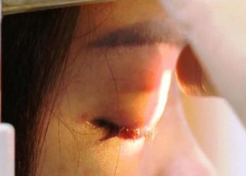 Cô gái ở Phú Thọ mù mắt do tiêm filler tại hàng… sửa móng tay