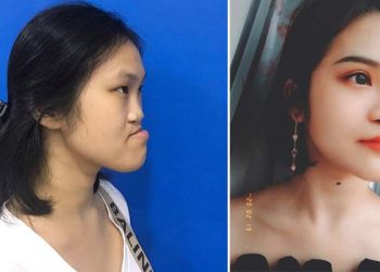 9X Phú Thọ “như được hồi sinh” sau 3 ca đại phẫu gương mặt