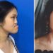 9X Phú Thọ “như được hồi sinh” sau 3 ca đại phẫu gương mặt