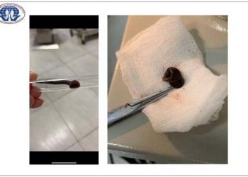 Phú Thọ: Con vắt dài 6cm sống trong mũi người đàn ông