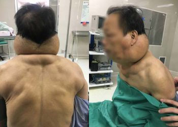 Quý ông biến dạng vùng cổ do nghiện rượu