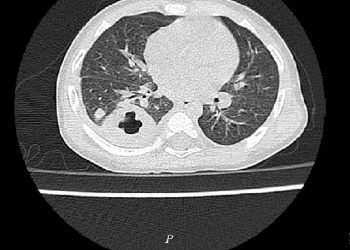 Bé 11 tháng tuổi ở Phú Thọ nhiễm “vi khuẩn ăn thịt người” – Whitmore
