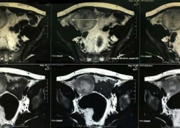 Ông bố ở Phú Thọ có 3 đứa con, mới biết tinh hoàn còn lại ẩn mình trong ổ bụng
