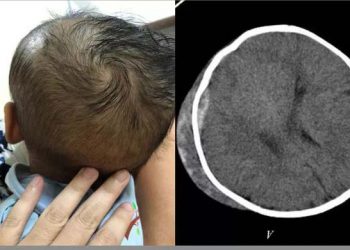 Phú Thọ: Tập đi bằng xe tròn, bé trai 6 tháng tuổi ngã tụ máu não