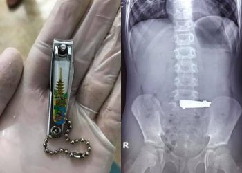 Bắt chước video YouTube, bé trai Phú Thọ nuốt chửng bấm móng tay vào bụng