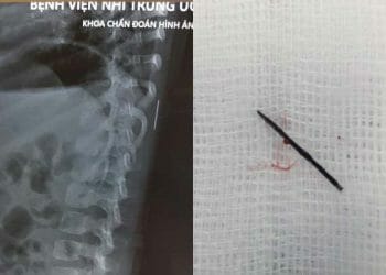 Kim khâu dài 17mm nằm trong cơ thể bé gái 3 tuổi ở Phú Thọ