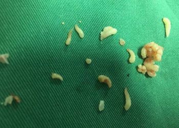 Bác sĩ ở Phú Thọ lấy ra gần 20 chiếc răng trong khối u của bệnh nhi 12 tuổi