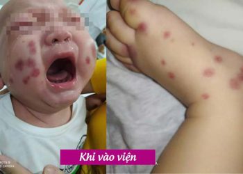 BV Sản Nhi Phú Thọ điều trị thành công bé trai 6 tháng tuổi mắc bệnh siêu hiếm, chưa từng gặp tại Việt Nam