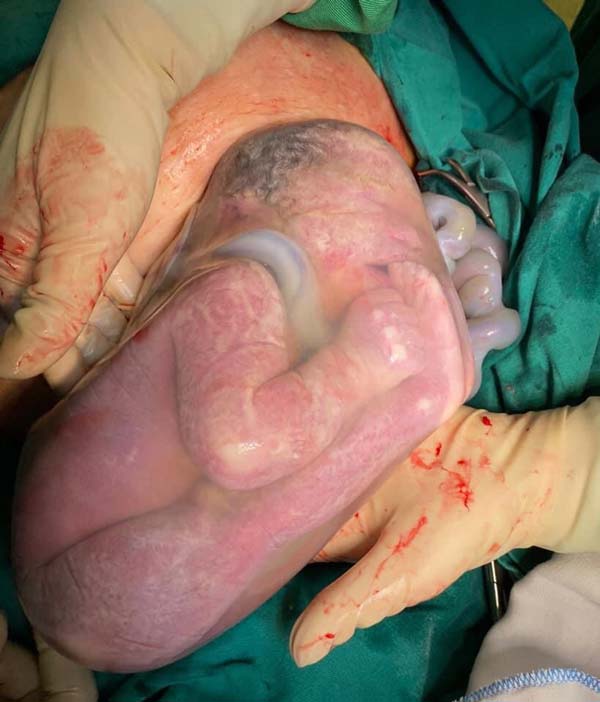 Phú Thọ: Ngắm bé sơ sinh chào đời nằm nguyên trong bọc ối rất đáng yêu