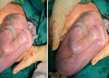 Phú Thọ: Ngắm bé sơ sinh chào đời nằm nguyên trong bọc ối rất đáng yêu