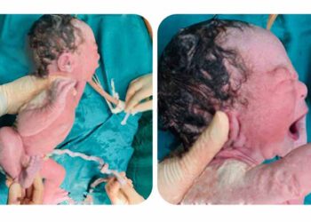 Bệnh viện Đa khoa thị xã Phú Thọ phẫu thuật lấy thai cấp cứu kịp thời sản phụ dọa vỡ tử cung trên sẹo mổ cũ, suy thai cấp