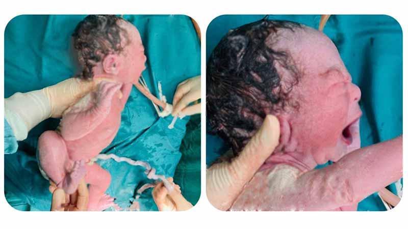 Bệnh viện Đa khoa thị xã Phú Thọ phẫu thuật lấy thai cấp cứu kịp thời sản phụ dọa vỡ tử cung trên sẹo mổ cũ, suy thai cấp