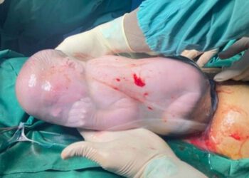 Bé sơ sinh ở Hạ Hòa, Phú Thọ còn nguyên trong bọc ối