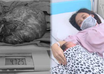 BV Sản Nhi tỉnh Phú Thọ phẫu thuật lấy thai kết hợp loại bỏ khối u nặng 4,7 kg cho sản phụ mang thai trên 38 tuần