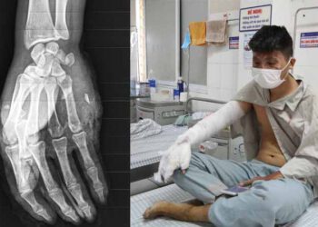 Nổ bình gas mini khi đang ăn lẩu, nam thanh niên bị bỏng nặng