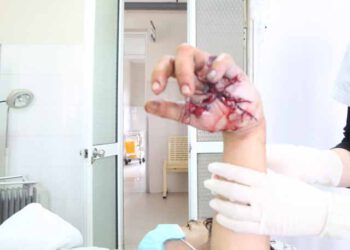 Tự chế pháo nổ – Cậu bé 14 tuổi suýt mất bàn tay