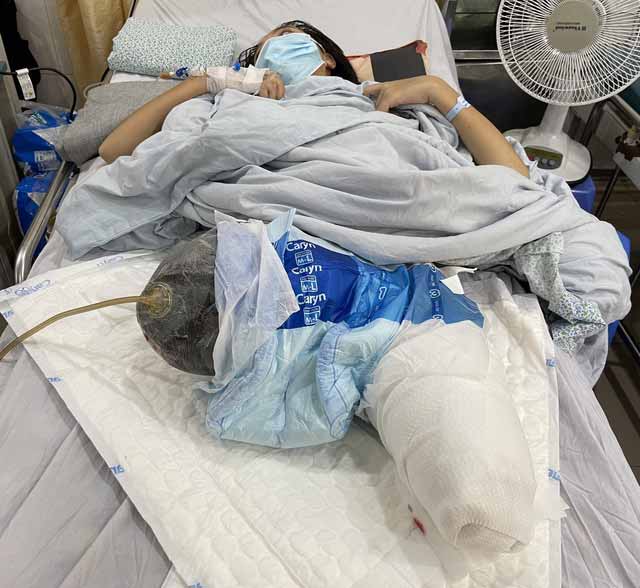 Cô gái 17 tuổi ở Phú Thọ bị tai nạn giao thông phải cắt cụt hai chân