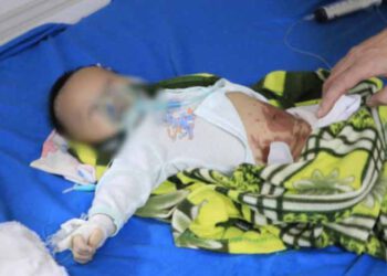 Đắp tỏi điều trị COVID-19, bé 2 tháng tuổi co giật, tím tái, nguy kịch