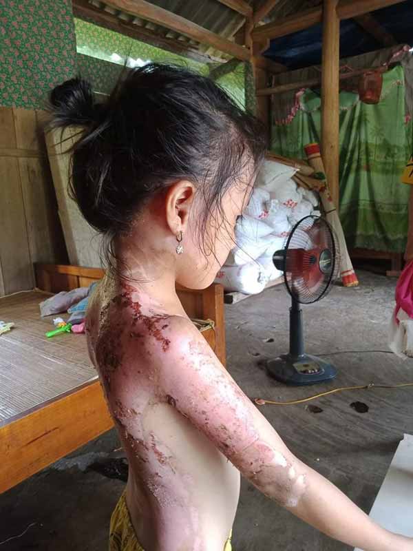 Công an Phú Thọ 'vào cuộc' vụ bé gái bị hàng xóm dội cả ấm nước sôi vào người