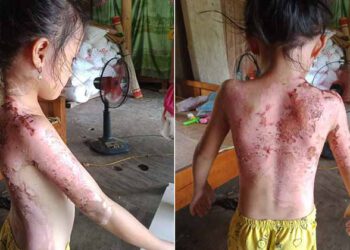 Công an Phú Thọ 'vào cuộc' vụ bé gái bị hàng xóm dội cả ấm nước sôi vào người