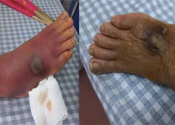 Một người ở Phú Thọ bị hoại tử chân vì chuột cắn